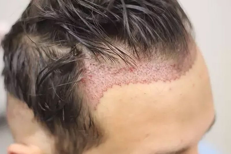 All-inclusive hair transplant